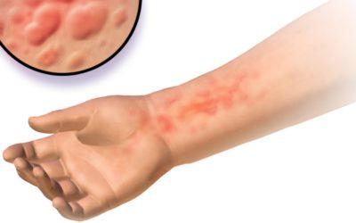 Treatments for Hives