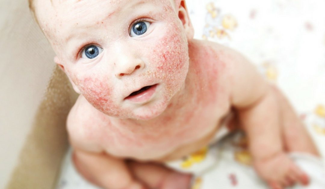 How to Treat Eczema for Kids