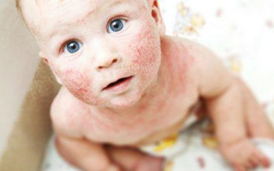 How to Treat Eczema for Kids