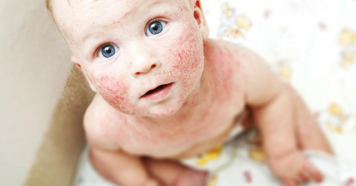 How to Treat Eczema for Kids MyDCSI