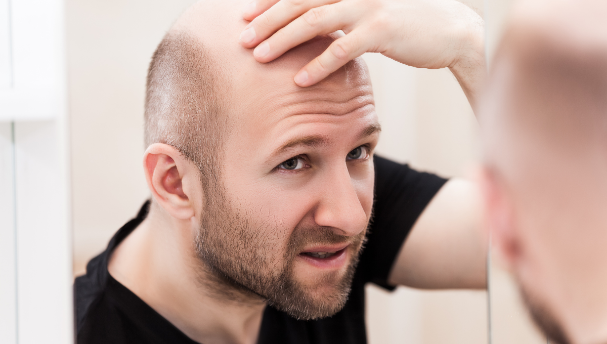 How is Baldness Genetically Inherited? - MyDCSI