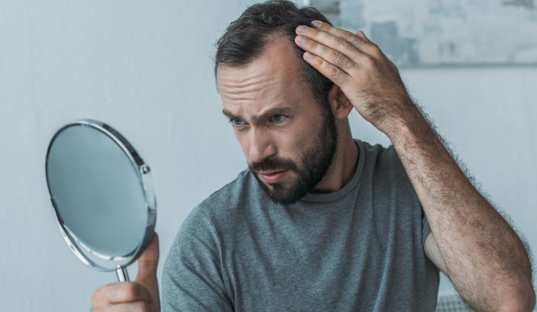 Male Hair Loss Facts - MyDCSI