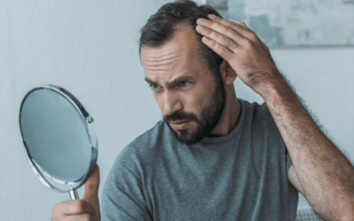 About Male Hair Loss