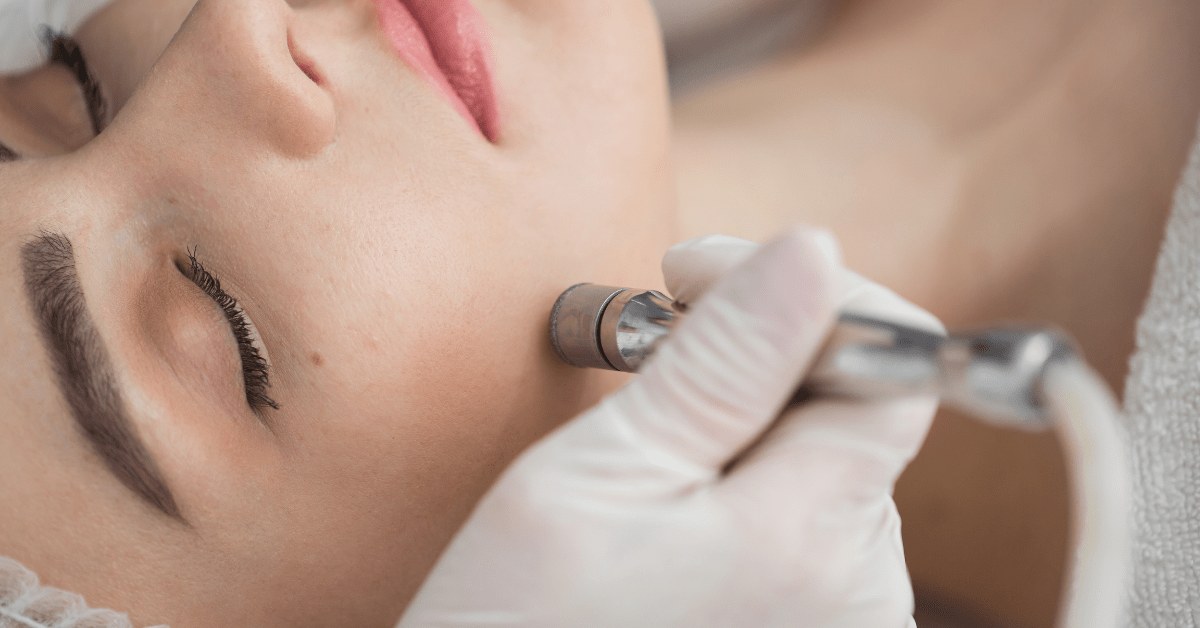 Microdermabrasion vs. Chemical Peels Pros and Cons DCSI