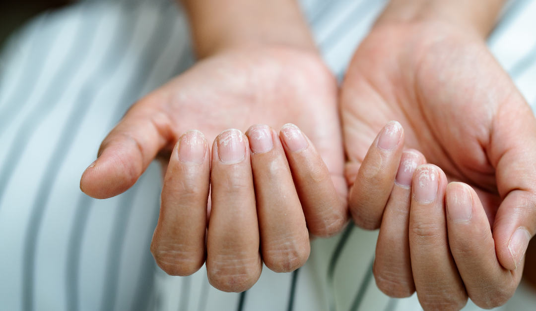 Brittle Nails | Causes, Symptoms, and Treatments, | DSCI