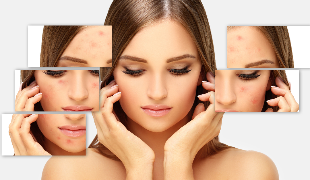 Acne Mapping