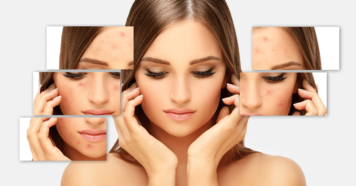 Acne Mapping | Possible Health Reasons Behind Breakouts | DCSI
