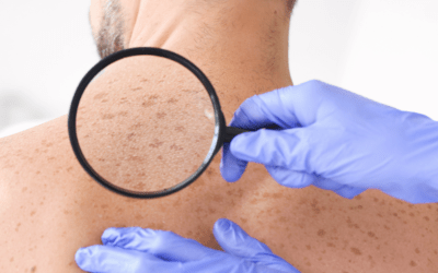 What Causes White Spots on Skin?