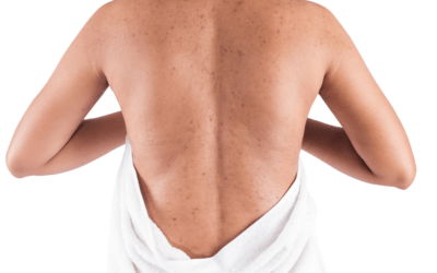 Best Products for Back Acne