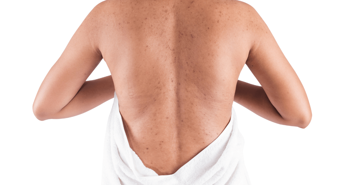 Best Products for Back Acne MyDCSI South Florida