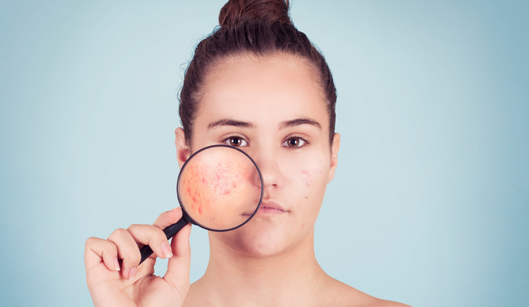 How to Treat Fungal Acne