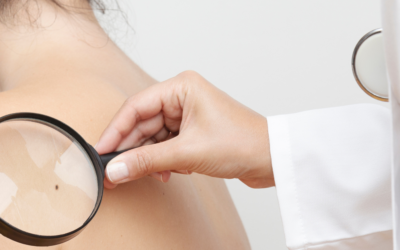 How to Avoid Skin Cancer