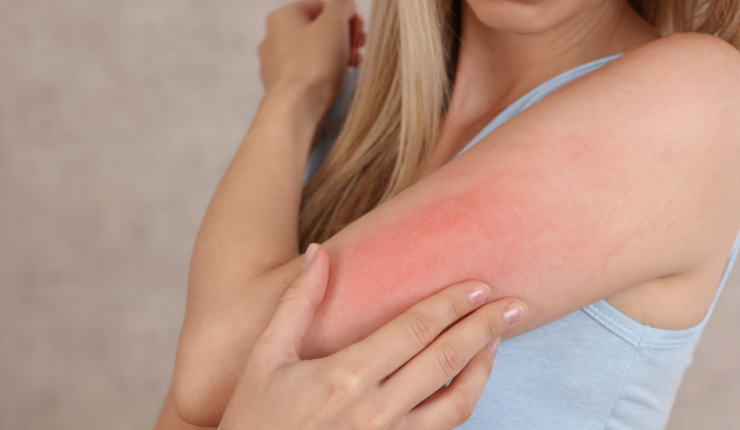 Do You Need Skin Allergy Treatment?