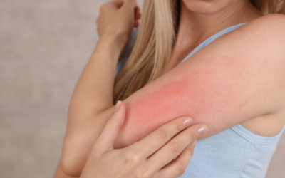 Do You Need Skin Allergy Treatment?