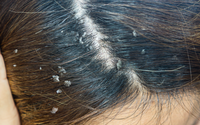 How Often to Wash Hair With Scalp Psoriasis: A Comprehensive Guide
