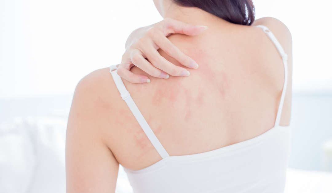 How to Get Rid of Eczema Scars: Expert Insights and Effective Treatments
