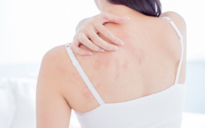 How to Get Rid of Eczema Scars: Expert Insights and Effective Treatments