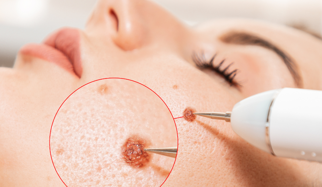 Does Mole Removal Leave a Scar? Understanding the Process and Aftercare