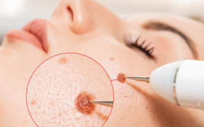 Does Mole Removal Leave a Scar? Understanding the Process and Aftercare