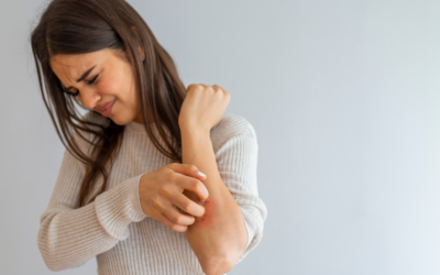 Should You Exfoliate Eczema? Navigating Skincare With Sensitivity