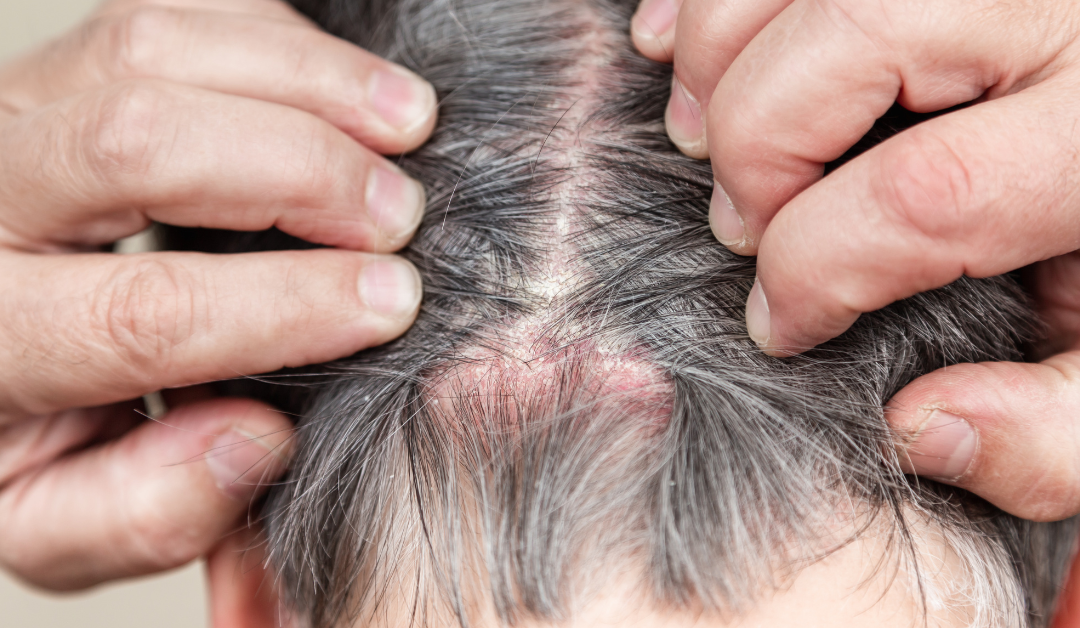 Is Short Hair Better for Scalp Psoriasis? Finding Comfort and Relief