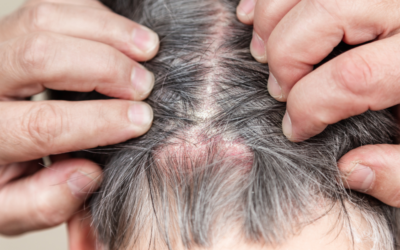 Is Short Hair Better for Scalp Psoriasis? Finding Comfort and Relief