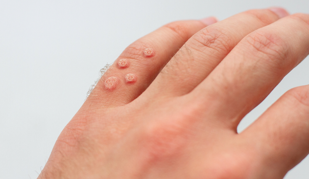 Can Dermatologists Remove Warts? Unveiling Effective Wart Removal Solutions