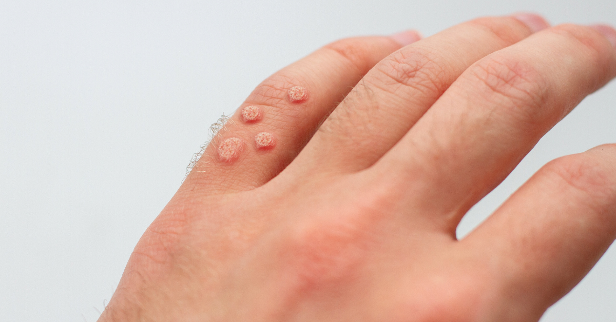 We Explain How Do Dermatologists Remove Warts DCSI
