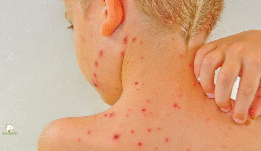 The History of Chickenpox and What It Means for Palm Beach County Families