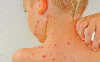 The History of Chickenpox and What It Means for Palm Beach County Families