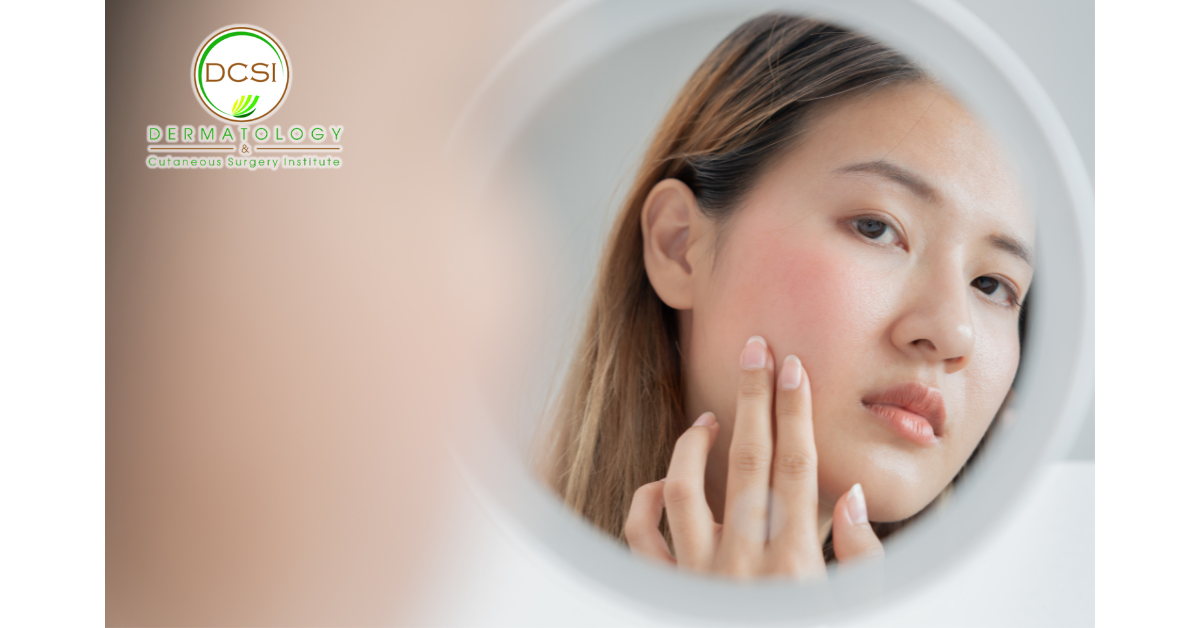 Treating Rosacea | Effective Management with DCSI