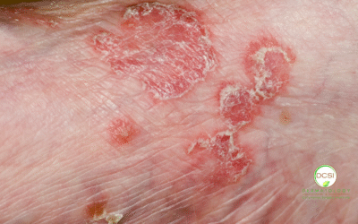 What Causes Vascular Skin Lesions?