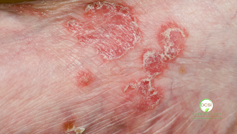 Vascular Skin Lesions: Causes & Solutions | DCSI