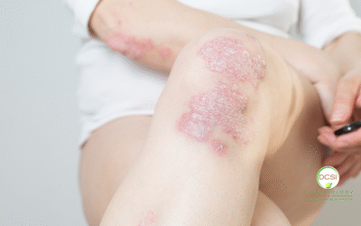 Your Autoimmune System and Your Skin