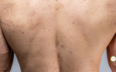 What Is Pityriasis Rosea?