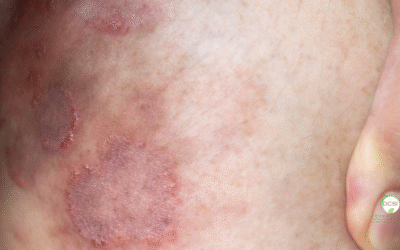 Ringworm Treatment in South Florida