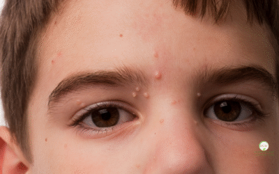 Molluscum Contagiosum Treatment: What Patients in Palm Beach County Should Know