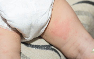 Diaper Rash Treatment: When to Seek Expert Care for Your Baby’s Skin