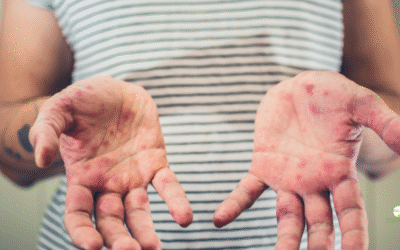 Hand, Foot, and Mouth Disease: What Palm Beach County Parents Should Know