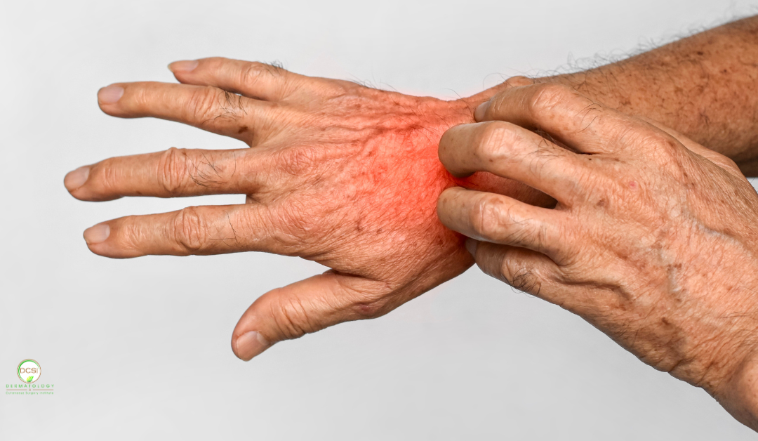 Psoriasis vs. Eczema: How to Identify Your Rash and Find Relief