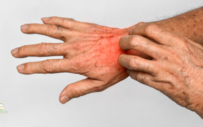 Psoriasis vs. Eczema: How to Identify Your Rash and Find Relief