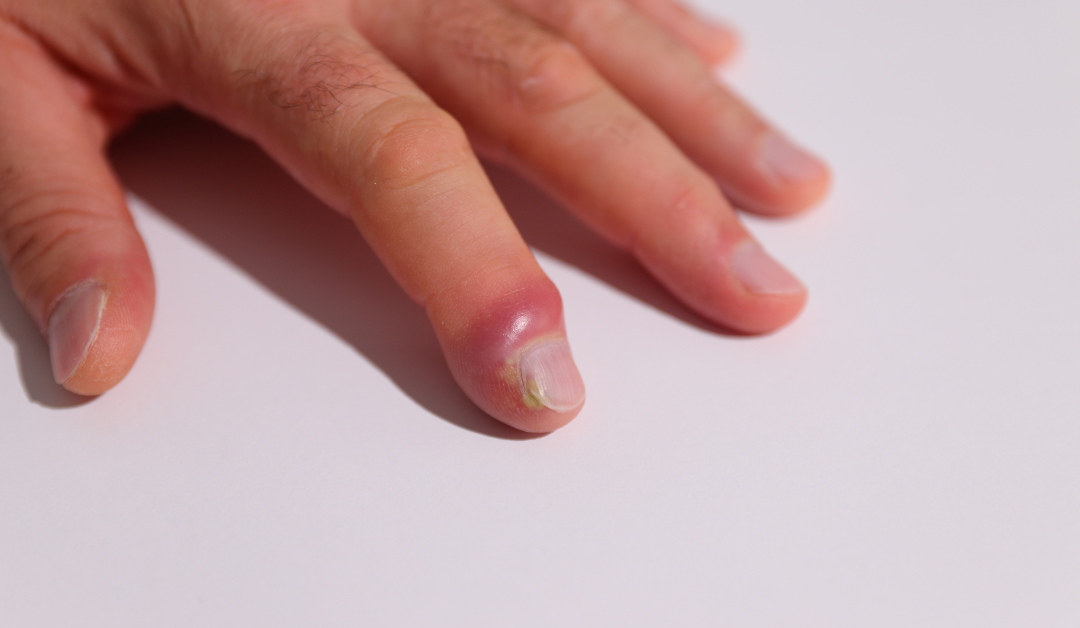 Dealing With a Painful Boil on Skin? Here’s What You Need to Know