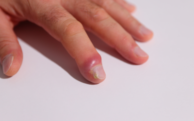 Dealing With a Painful Boil on Skin? Here’s What You Need to Know