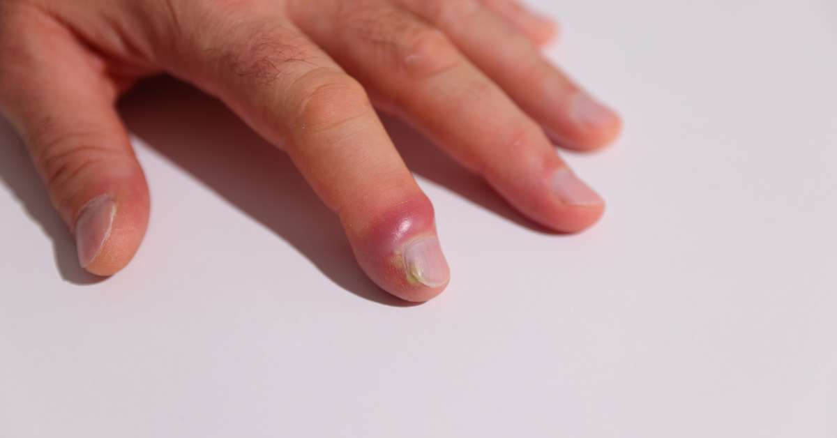 Boil on Skin: Causes, Treatment & Care in South Florida | DCSI